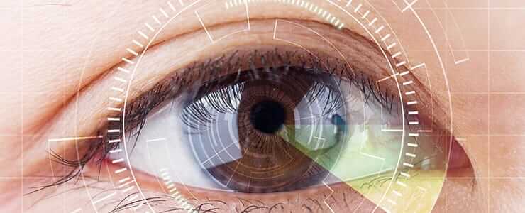 Cataracts Cataracts